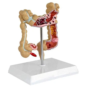 Модел болестно рак на дебелото черво, модел на рак на дебелото черво, анатомическая модел на дебелото черво, модел на стомашно-чревния тракт